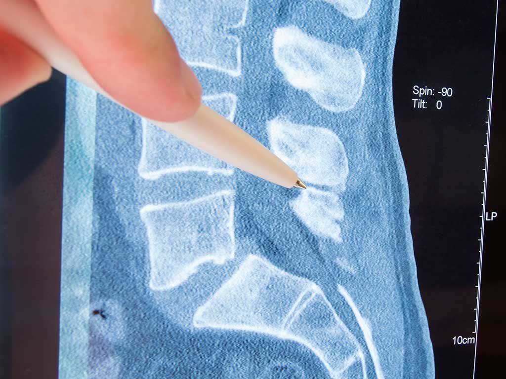 West End News - Back pain - MRI lumbosacral spine