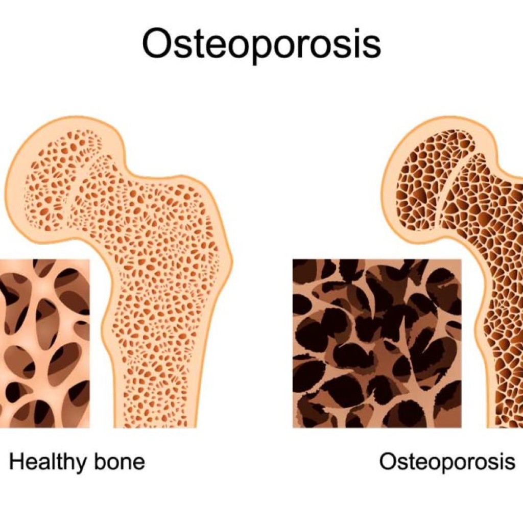 Osteoporosis When bones break easily The West End News