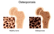 Osteoporosis: When bones break easily