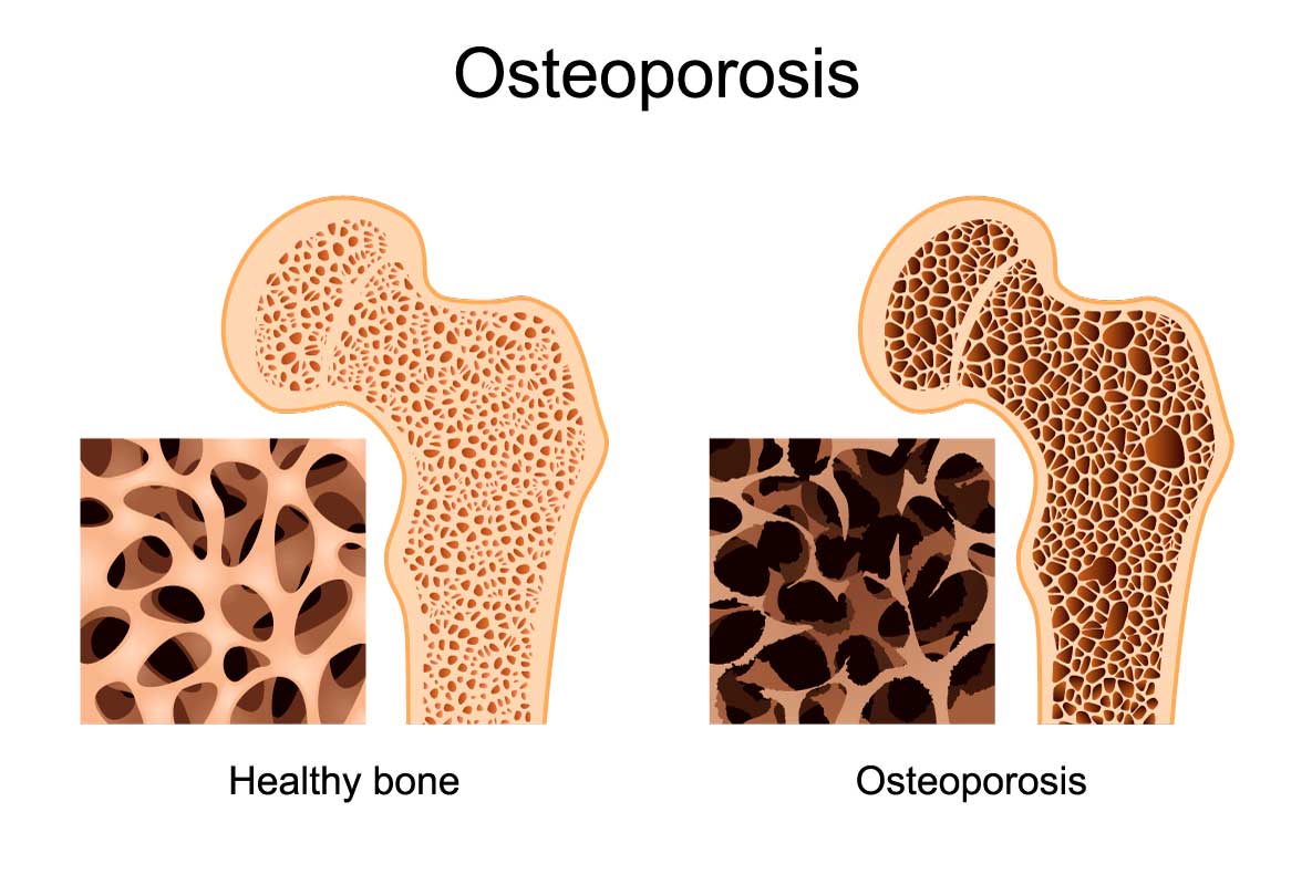 Osteoporosis: When bones break easily - The West End News