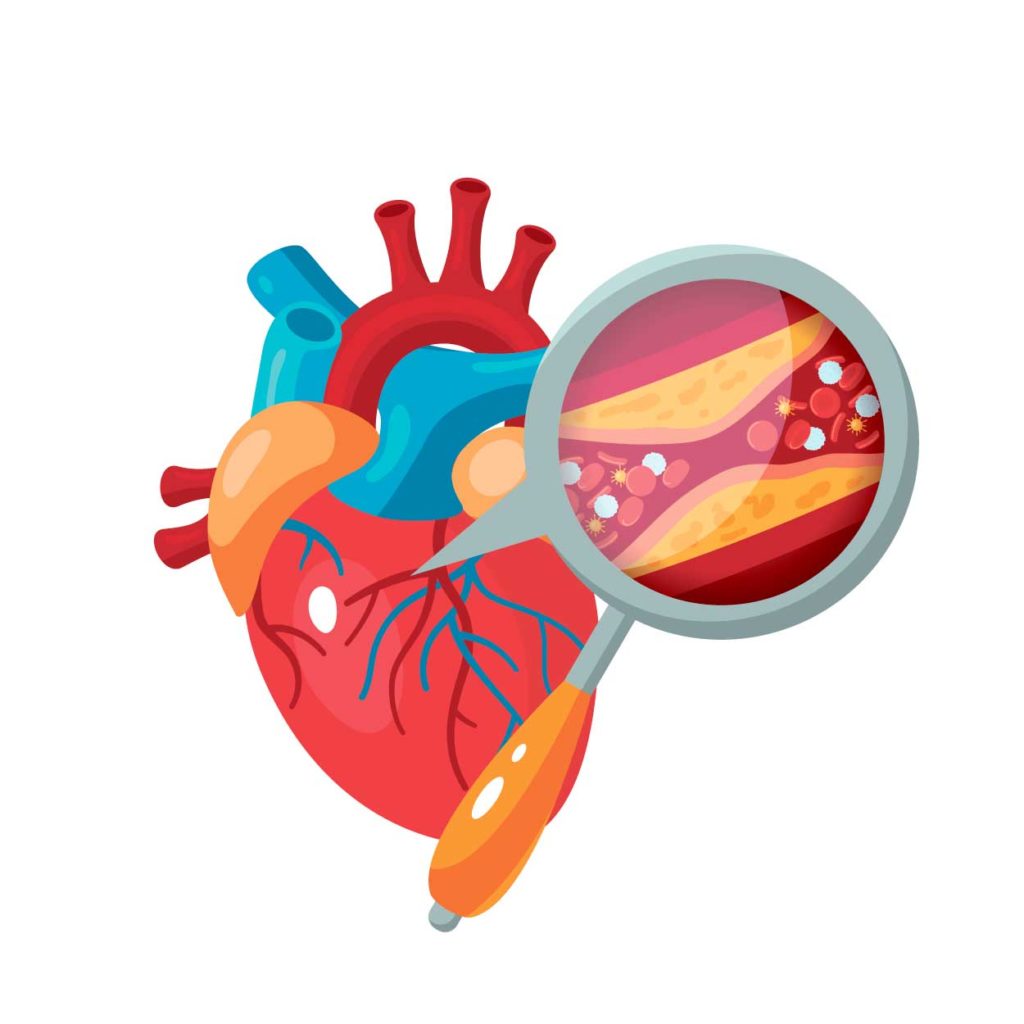 West End News - Coronary artery disease concept - heart disease - heart health - Adobe stock image